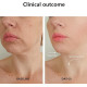 Infrared Red Blue LED Light Therapy Face and Neck Thermal Beauty Machine 